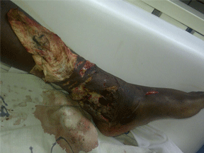 Photo of Leg Wounds